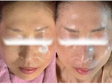 ルミア(LUMIA)/目元・口元+肌ツヤUP◎導入&洗浄