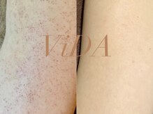 ヴィーダ 渋谷松濤(ViDA)/二の腕DT有りハーブピーリング