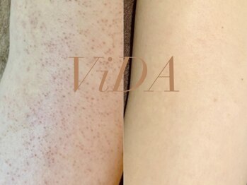 ヴィーダ 渋谷松濤(ViDA)/二の腕DT有りハーブピーリング