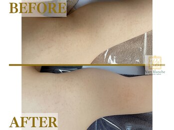 ヴェールブランシュ 町田(Vert Blanche)/#ブライダルエステ#痩身#二の腕