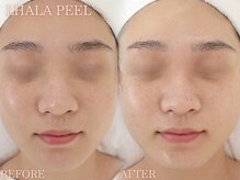 レイネ(REINE)/韓国肌管理★ララピール