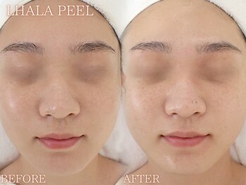 レイネ(REINE)/韓国肌管理★ララピール