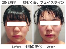 マテリアル(MATERIAL)/一度であごラインくっきり！