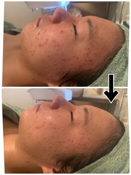 ルーチェ(LUCE)/贅沢肌別パック小顔フェイシャル