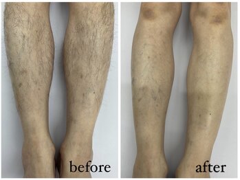 プレジール(PLAISIR)/メンズ脱毛 Before・After