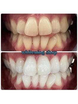 ホワイトニングショップ 和歌山店/Before&After美白ホワイトニング