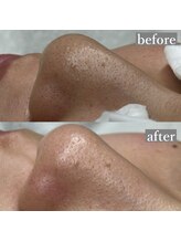 ライカブルー(RaicA BluE)/施術写真　before-after
