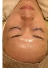 アドビューティ(Add Beauty)/≪たるみ改善／RFリフティング≫