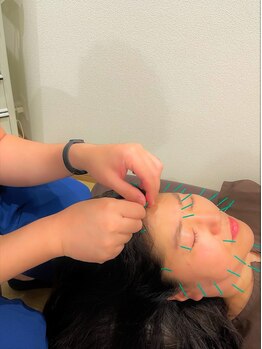 ライジング鍼灸接骨院/美容鍼×小顔整体