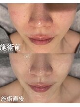 オリエンタルビューティー(ORIENTAL BEAUTY)/プラズマ×ハーブピーリング