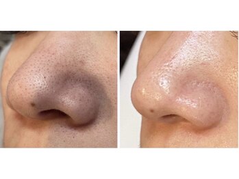 エヴァーグレース 河原町店/京都河原町の毛穴改善美肌サロン