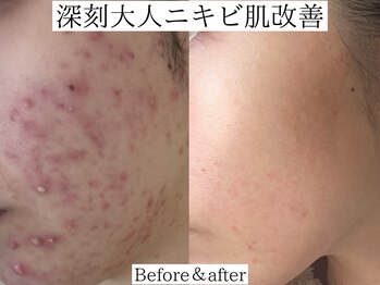 プラウディア(PROUDIA)/ニキビケア専門/肌荒れ/ハーブ