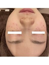 ラディエンス 多治見店/ピンポイントシミケア