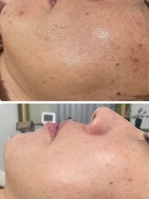 ベルフィーヌ ノーブル(BELLEFINE noble)/シミケアでお肌全体が綺麗に