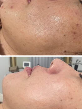 ベルフィーヌ ノーブル(BELLEFINE noble)/シミケアでお肌全体が綺麗に