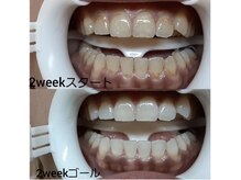 ホワイトニングセンター 京都長岡京店/長岡京・大山崎ホワイトニング