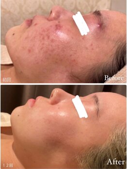 ルーヴェ(Luve)/陶肌トリートメント