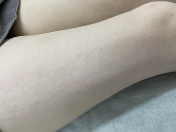 ナノハナ/鹿沼市全身脱毛美容室ナノハナ