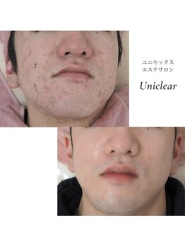 ユニクリア(Uni clear)/ニキビケア