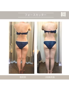 カリスボーテ 関本店/フォースカッター