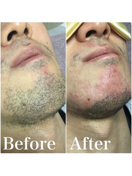 トータルメンズエステ キング(KING)/■電気脱毛■どこの部位もOK！