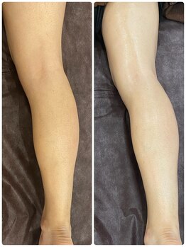 ボニート 堺東店(BONITO)/メンズ足脱毛