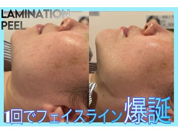 ヴィオール 名古屋栄店(VIOR)/光Vショットと併用でEライン激変