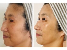 れふぇるん 足利店/50代くすみ＆たるみ改善 施術1回