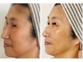 れふぇるん 足利店/50代くすみ&たるみ改善 施術1回