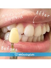 ホワイトニングカフェ 熊本店(WhiteningCafe)/◎歯のホワイトニング症例写真◎