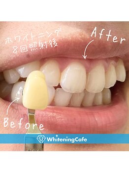 ホワイトニングカフェ 熊本店(WhiteningCafe)/◎歯のホワイトニング症例写真◎