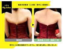 イエス マイサロン(yes My Salon)/脂肪冷却痩身施術例
