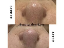 レーヴの雰囲気（小鼻の黒ずみをしっかり除去する毛穴洗浄が人気です♪）