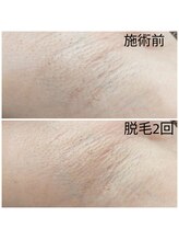 エミナル(EMINAL)/～脇脱毛の効果～女性