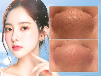 ウィア 越谷店(Uvia)の写真/メイクノリ抜群≪医療提携≫毛穴の汚れ・角質を徹底洗浄【韓国式3Dハイドラ毛穴洗浄60分5800円】毛穴レス肌