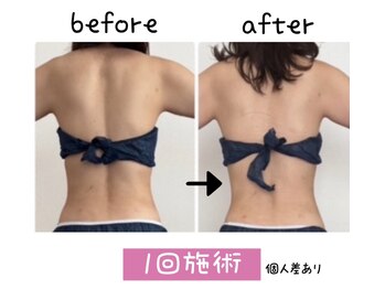 ピースツリー(PEACE TREE)の写真/つらい肩こりも気になる背肉も一緒にケア♪