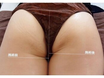 メルシー/リンパ光ヒップケア