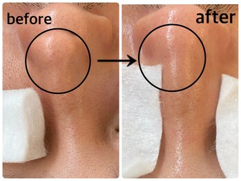 毛穴専科/ワックス脱毛メンズok/沖縄/那覇