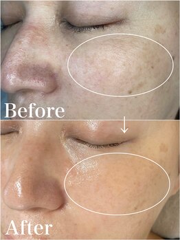 アッシュ(Ash)/肌質改善!!毛穴改善