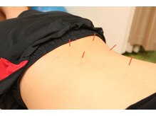 ユミー/施術風景～鍼