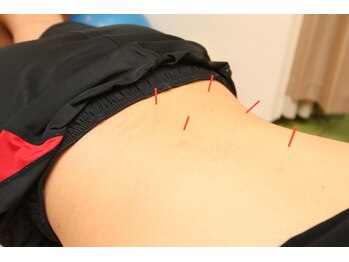 ユミー/施術風景~鍼