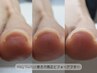 フット☆巻き爪矯正3回以降　〇ジェルワンカラー＆親指キープジェル　¥10400