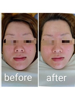 美藤鍼灸院/美容鍼のBefore After