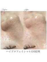 フォトビズ/ハイドロ毛穴洗浄＆フォト組合術