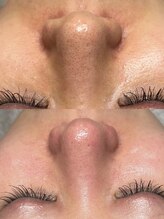 韓国肌管理室ハナ(hana)/究極肌管理【肌質改善/毛穴】