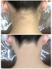 【女性☆全身丸ごと脱毛】顔うなじ込み♪（VIO無し）初回¥4,400