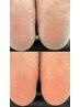 《FOOT》クイック角質ケアのみ　￥2000