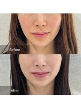 ラ クレール ビューティーサロン(LA CLAIR)/デトックスヘッド×サーマリフト