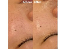 グレアージュ(GLEAGE)/水光イオン導入！