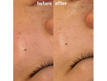 グレアージュ(GLEAGE)/水光イオン導入!